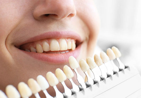 Vaneers Treatment in Jaipur